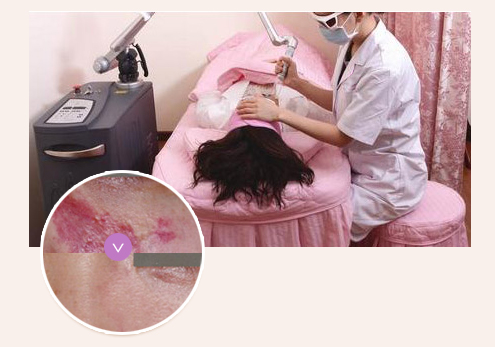 宁波激光去胎记_胎记怎么去除_去除白色胎记