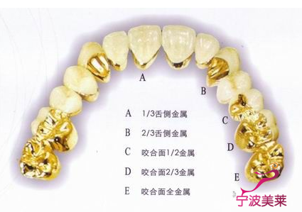 黄金烤瓷牙好不好?优缺点有哪些?-宁波美莱整